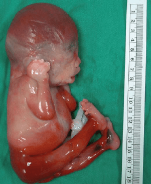 Zabrana abortusa u Srbiji pravo ili potreba