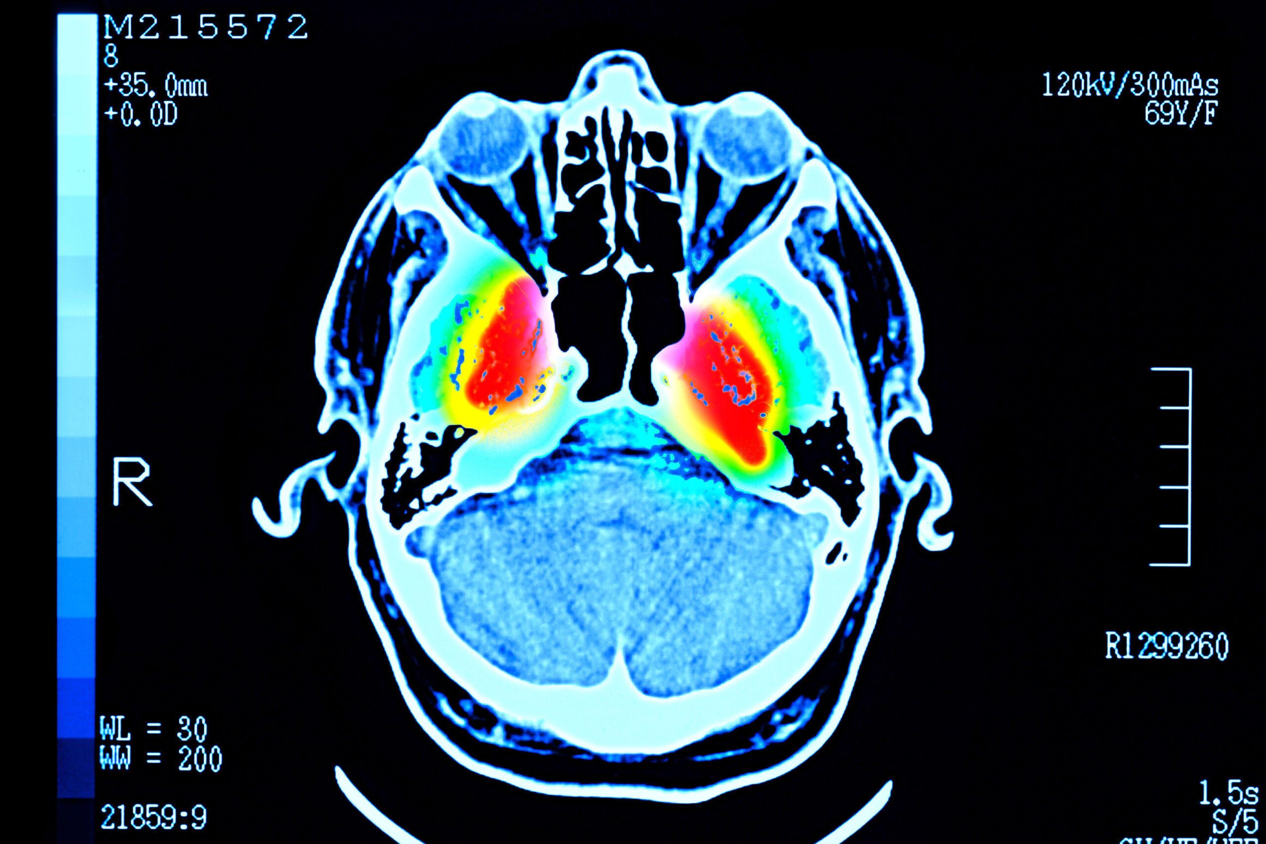 Skeniranje ljudskog mozga prikazuje crvene oblasti oko centra, okružene žutim, zelenim i svetloplavim oblastima