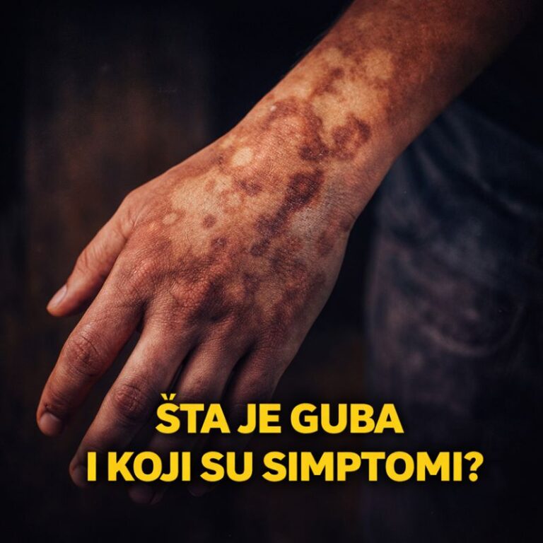 šta je guba i koji su simptomi informacije o gubi i lepri na Blkanu i u Srbiji