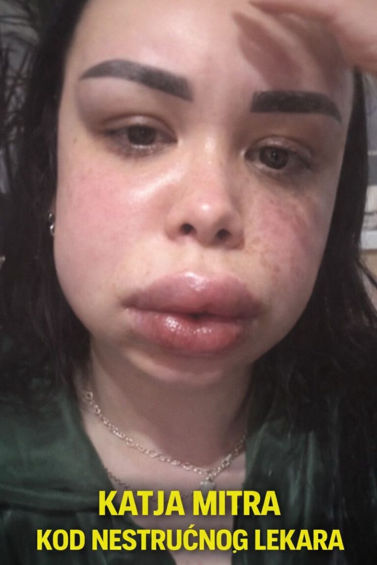 Katja Mitra kod nestručnog lekara – skandalozne usne nikad vidjeno