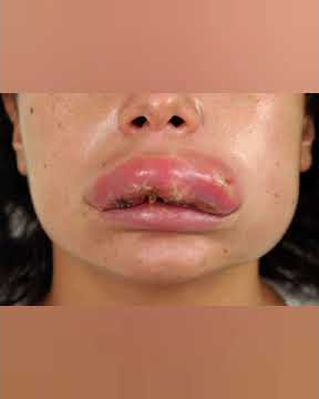 saneli eksplodirale usne zbog hijalurona