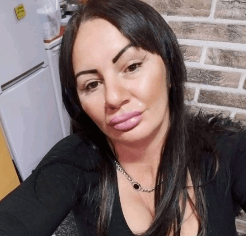 saneli eksplodirale usne zbog hijalurona