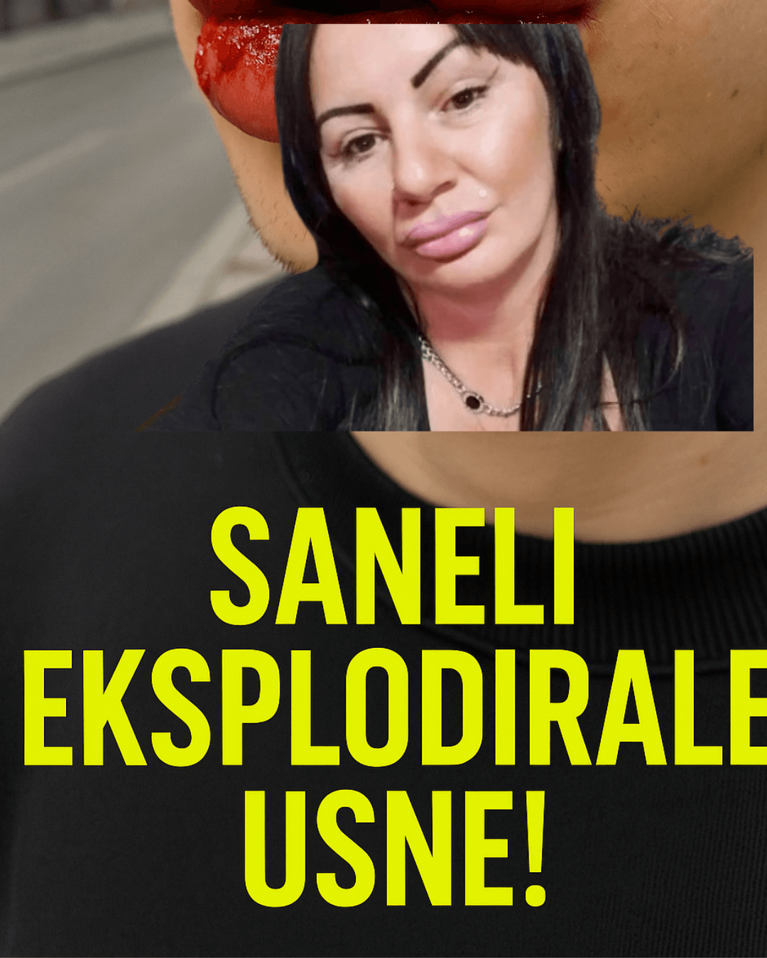 saneli eksplodirale usne zbog hijalurona